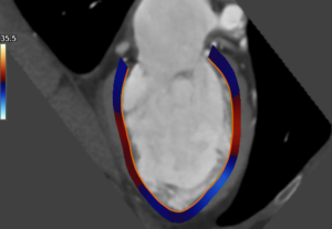 Medis Suite CT – LV strain