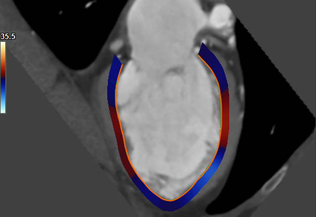 Medis Suite CT – LV strain