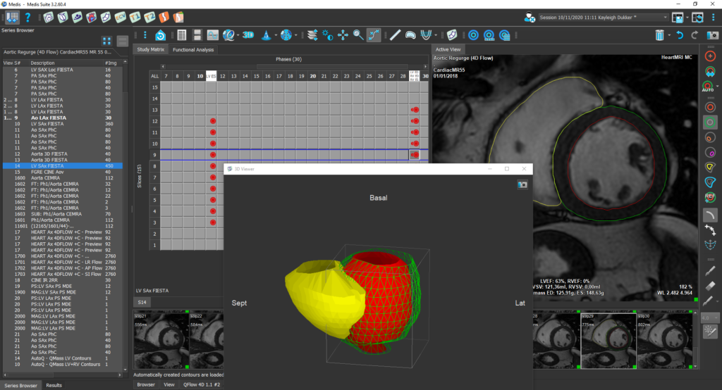 Medis Suite MR Clinical Applications LV/RV Function