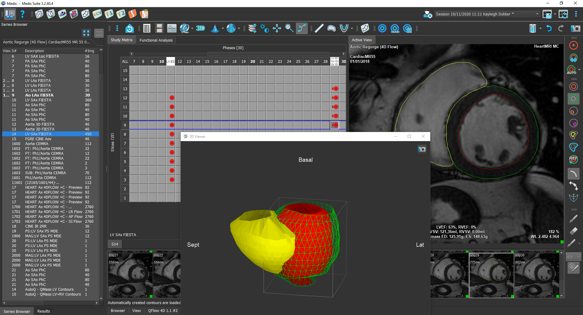 Medis Suite MR Clinical Applications LV/RV Function