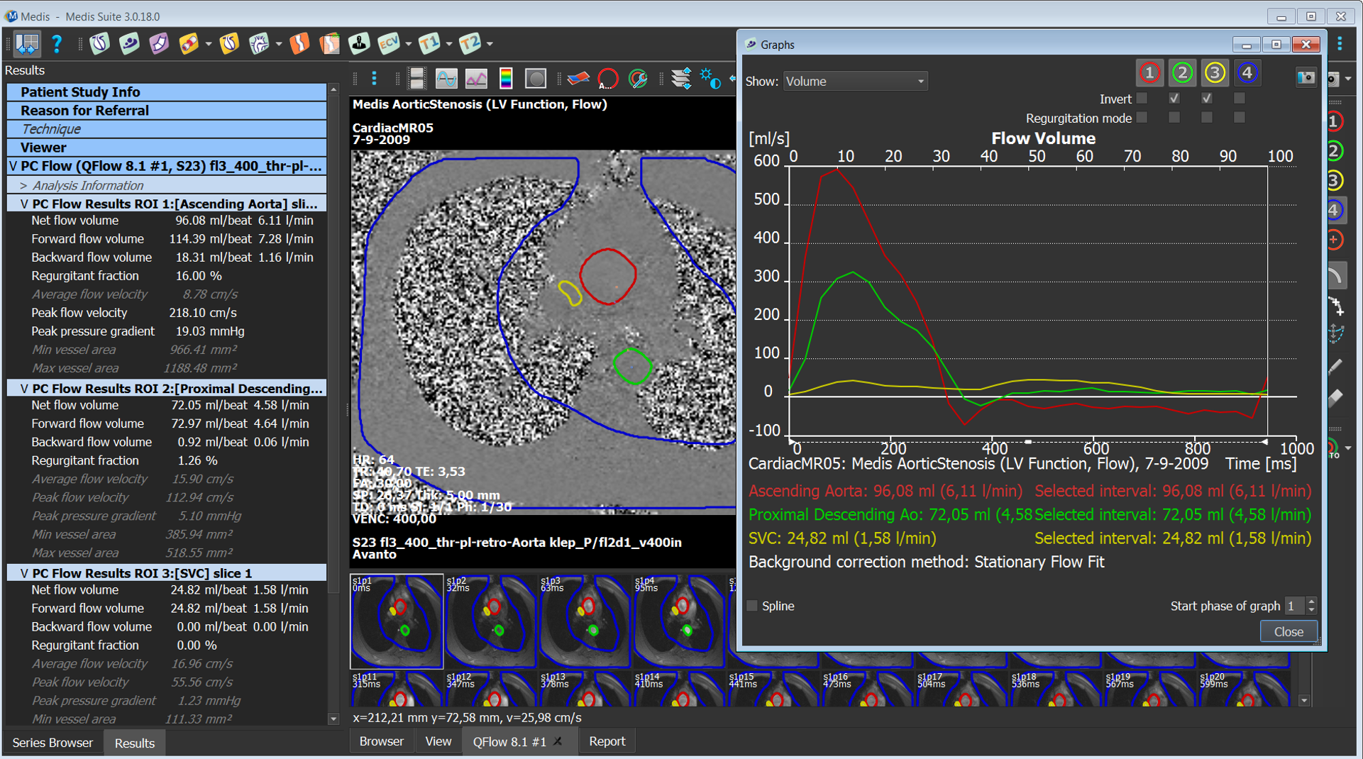 PCFlow_AorticStenosis
