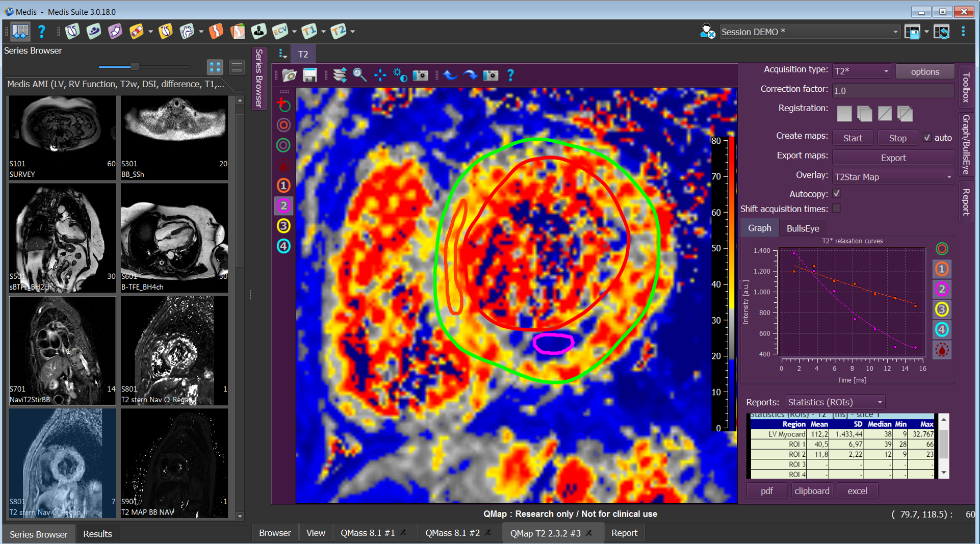 QMap_T2Star_Haemmorrhage