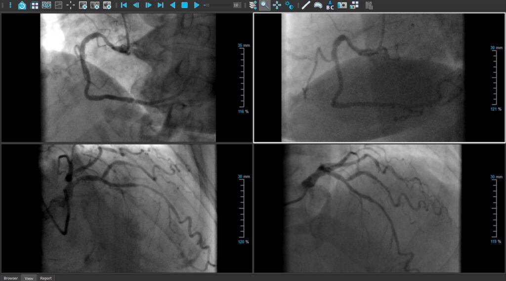 Medis Suite XA - viewer RCA LAD