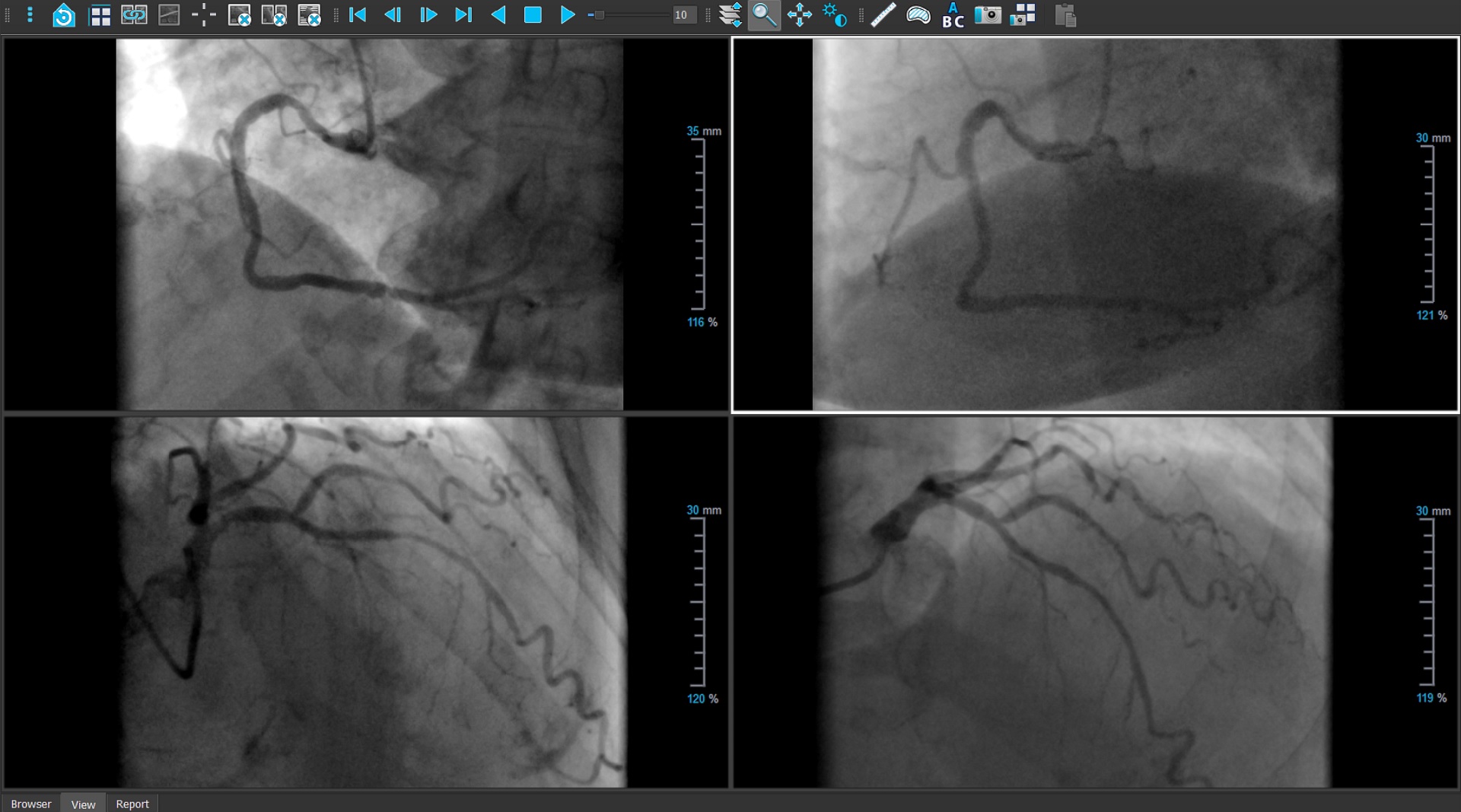 Medis Suite XA - viewer RCA LAD