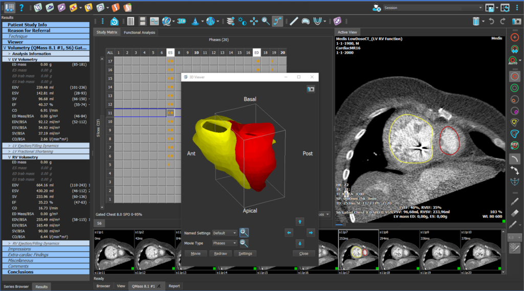 Medis Suite CT – LV/RV Function photo illustration
