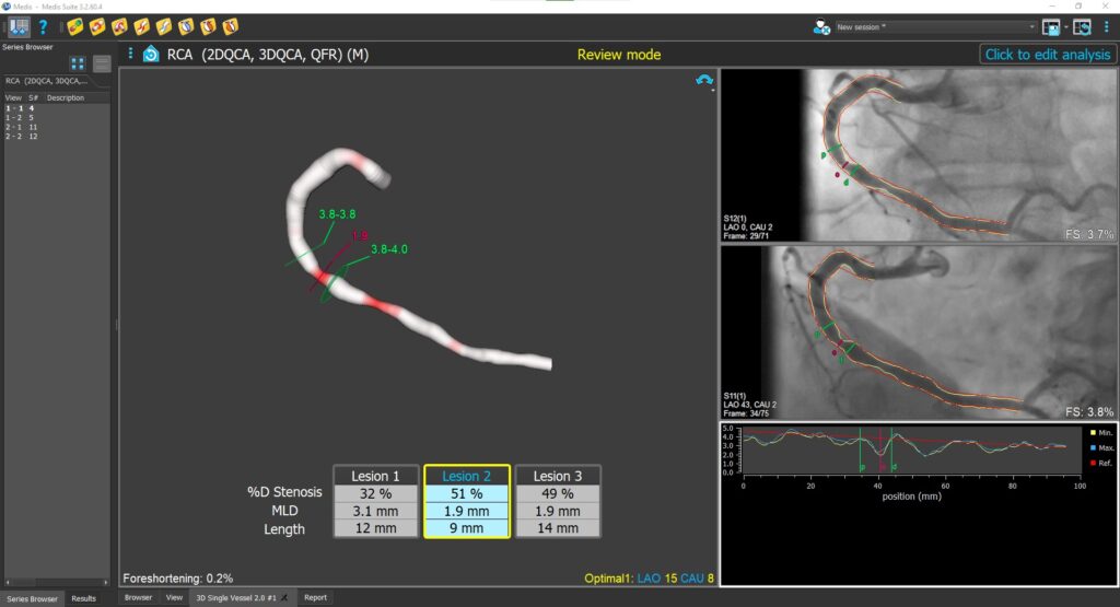 3D QCA Single Vessel