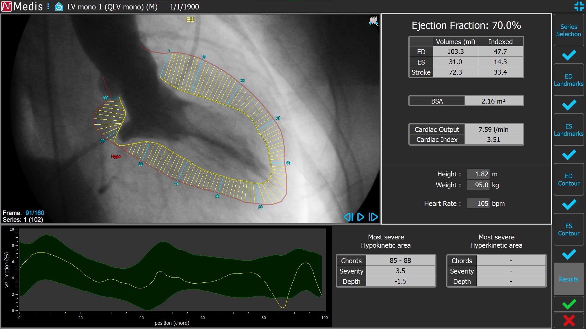 Medis Suite XA LV Monoplane 6 Results