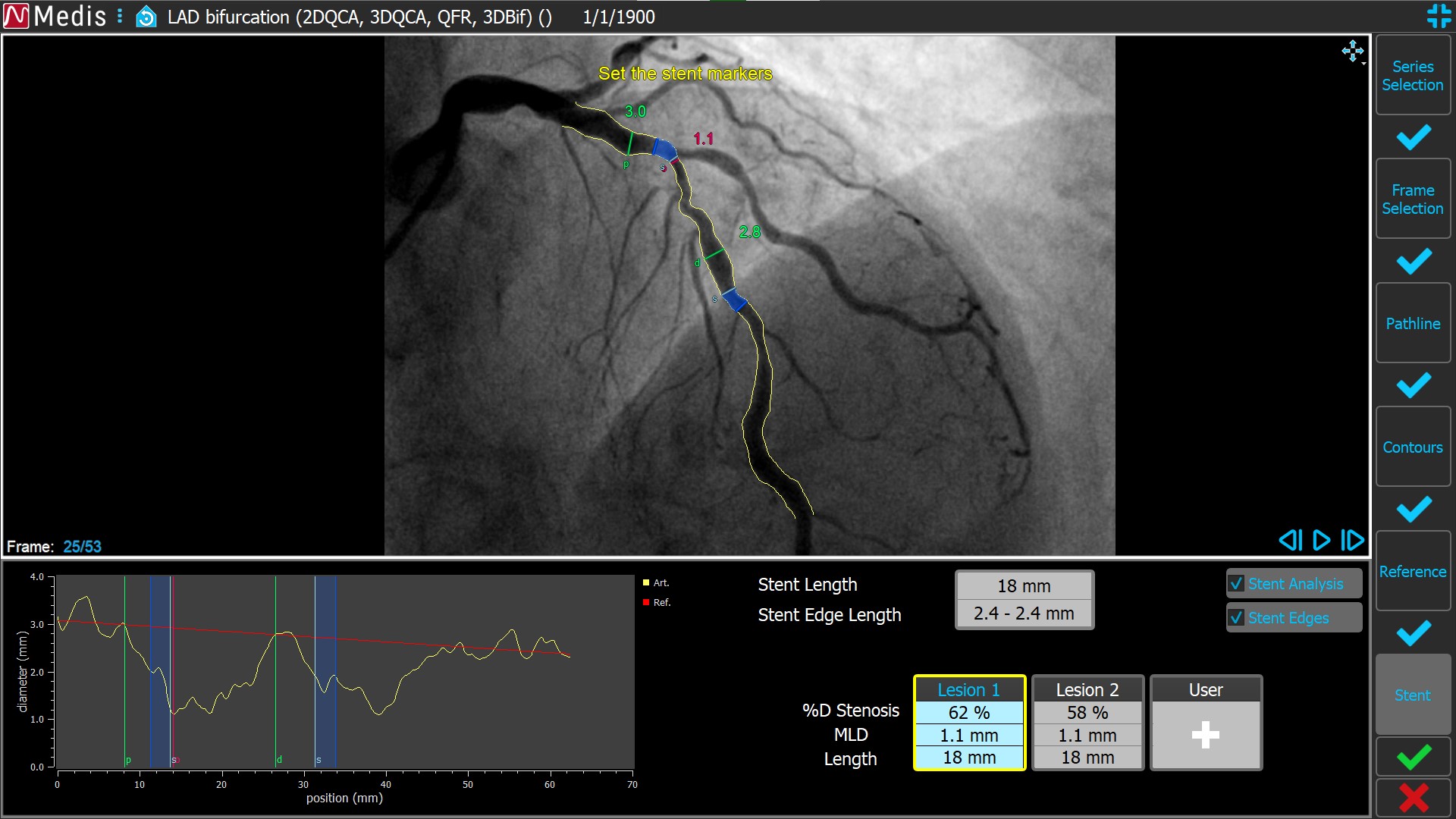 Medis Suite XA 3D QCA Single Vessel 6 Stent