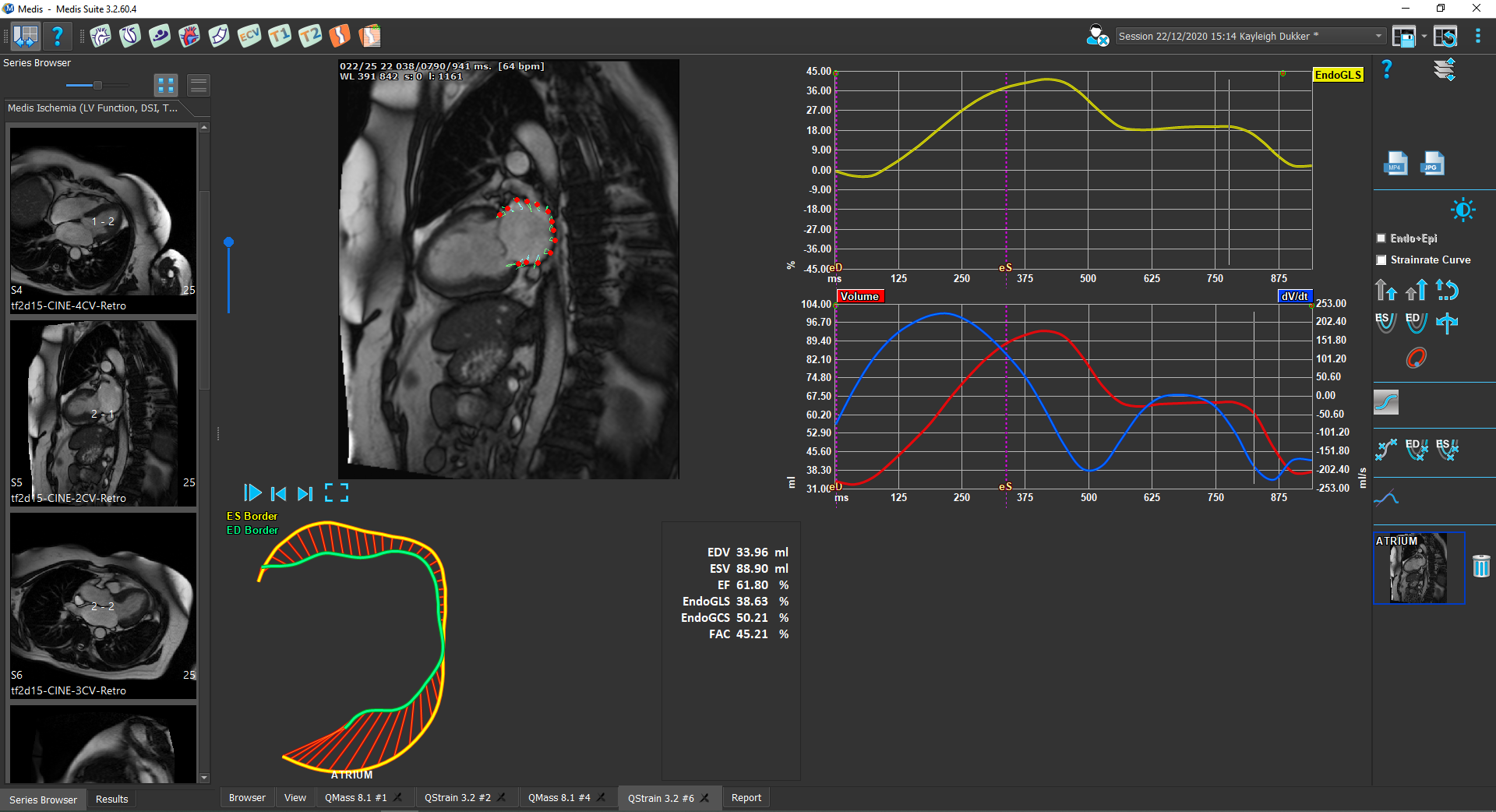 Medis Suite MR – Atrial Strain