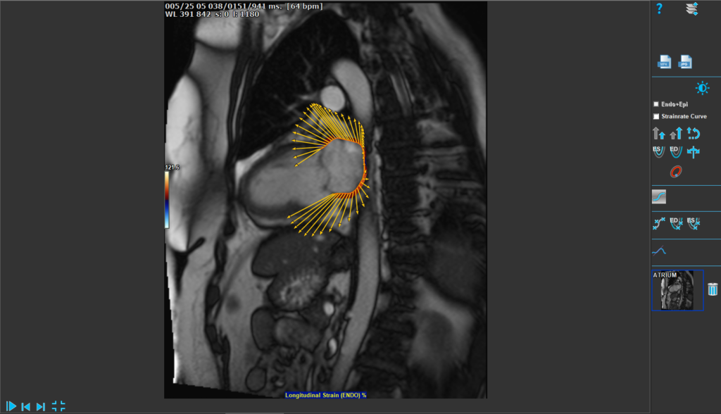 Medis Suite MR – Atrial Strain Features