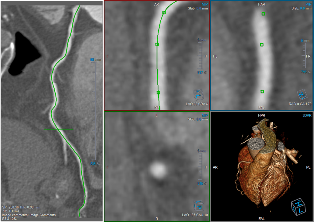Medis Suite CT – 3D View CPR