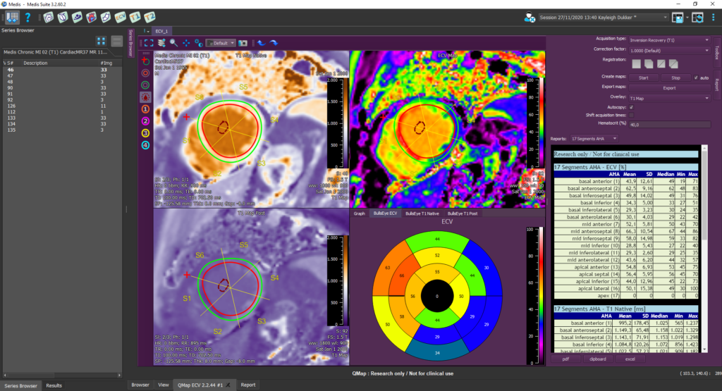 Medis Suite MR Extracellular Volume Research