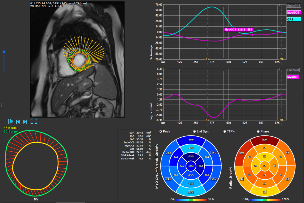 Medis Suite MR - LV Strain Module 1