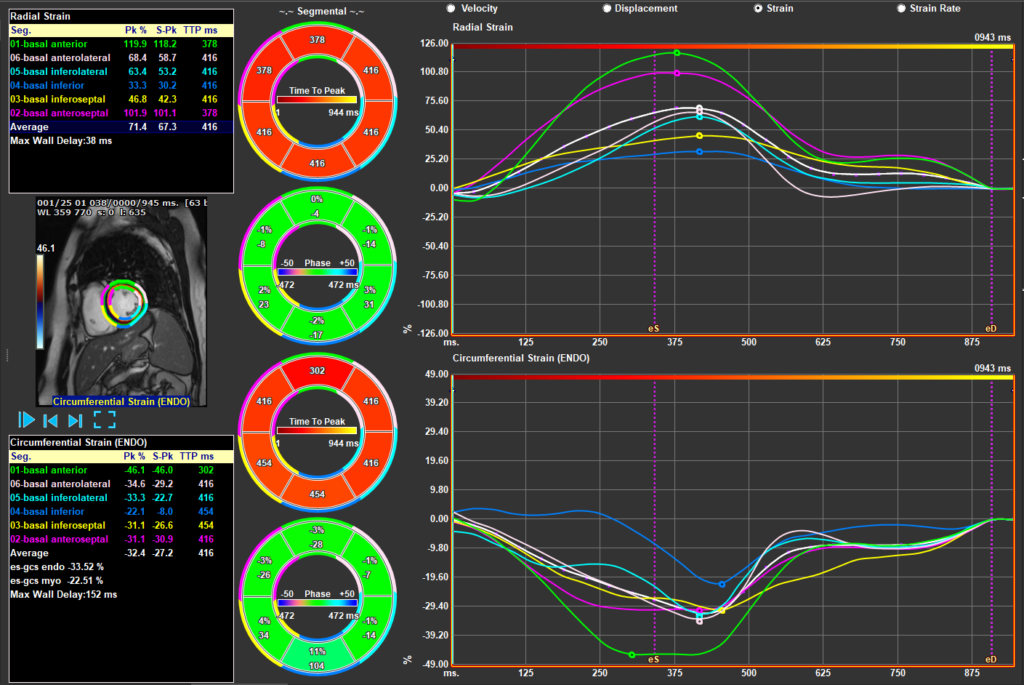 Medis Suite MR - LV Strain Module 2