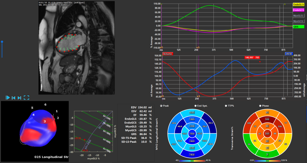 Medis Suite MR - LV Strain Module 2