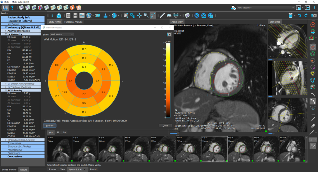 Medis Suite MR LV & RV function Features Module 2