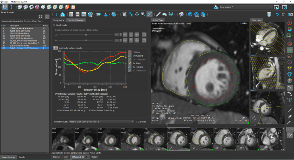 Medis Suite MR LV & RV function Features Module 3