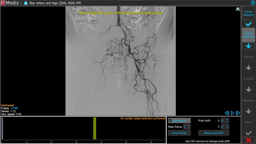 Medis Suite XA 3D QCA Single Vessel QVA subtraction