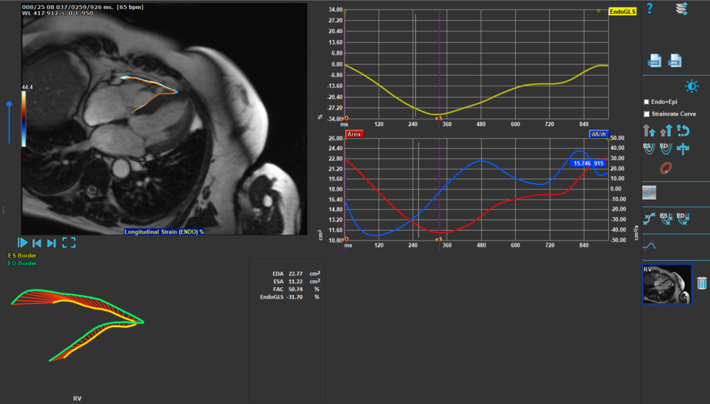 Medis Suite MR RV Strain Module 1 Features