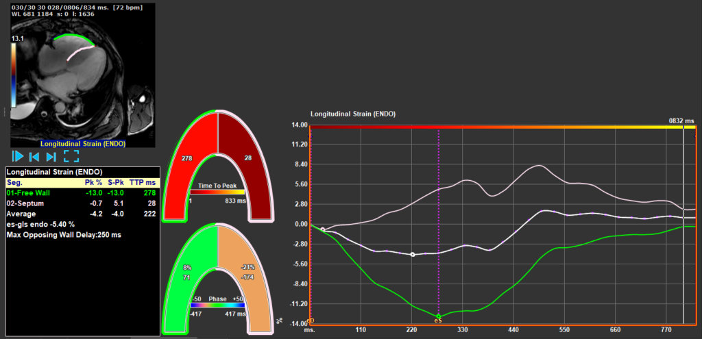 Medis Suite MR RV Strain Module 2 Features
