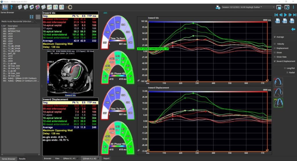 inward displaccement