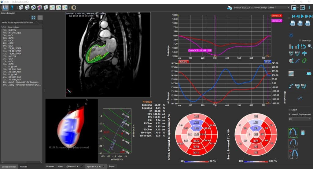 inward displaccement