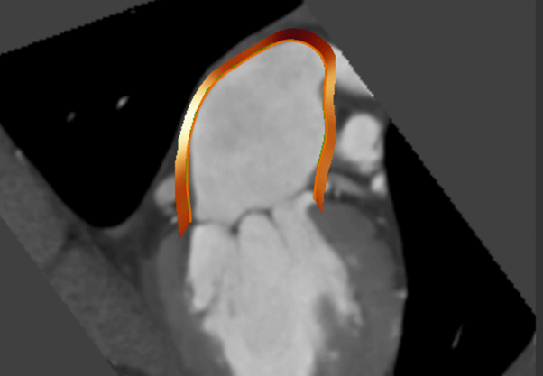 Medis Suite CT Atrial Strain