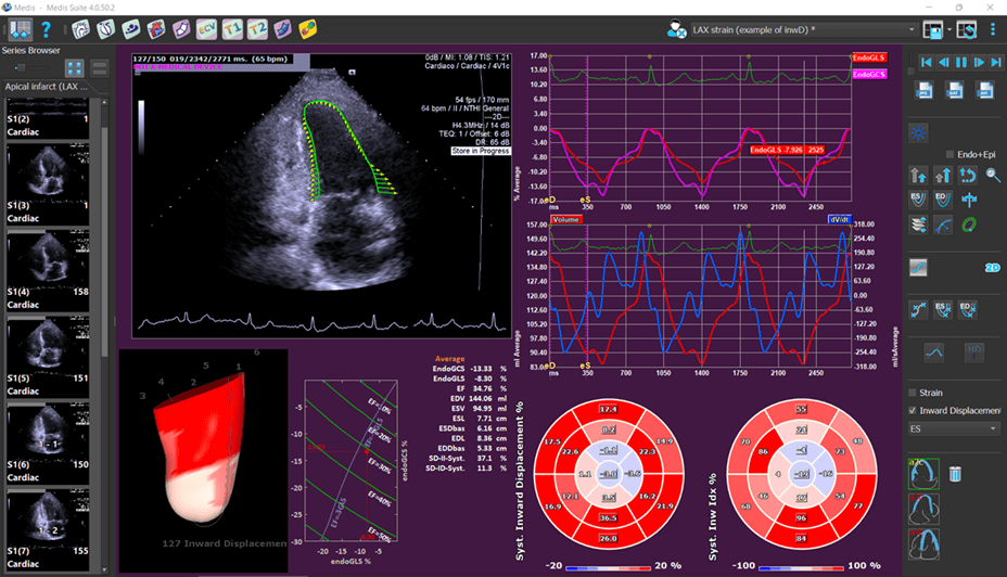 Medis Ultrasound Inward Displacement Inwd