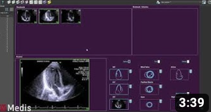 Metrics of the heart: Motion | Inward Displacement