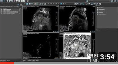 MR explained: T1 MOCO Maps